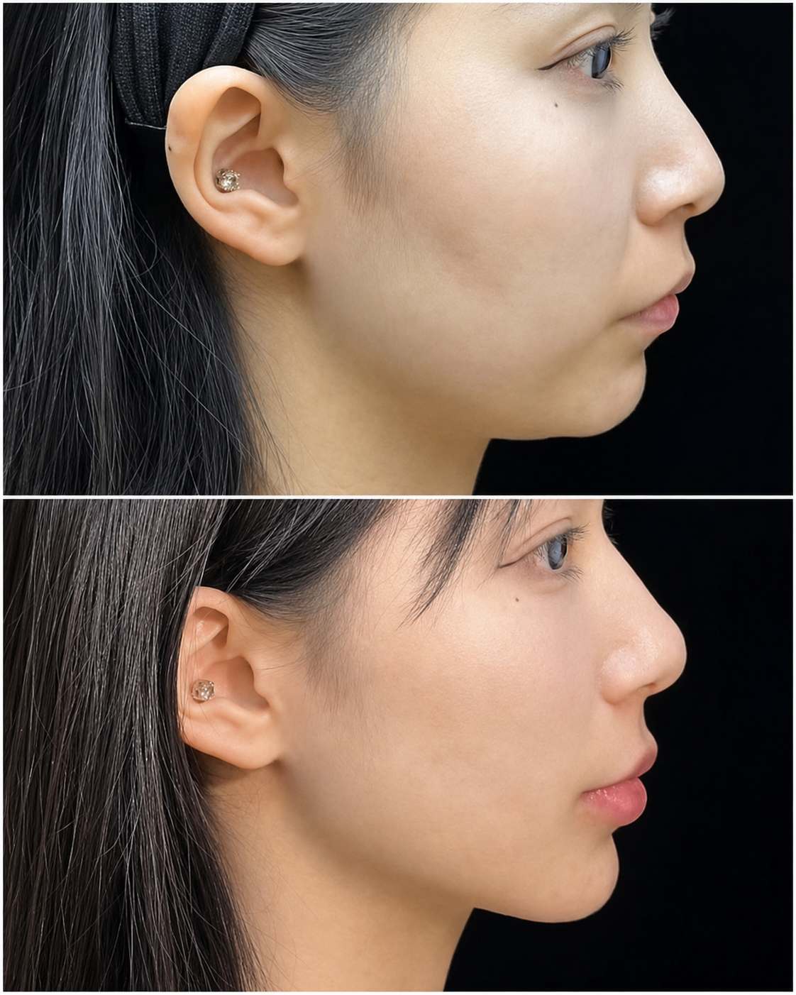 Dermal filler before and after — SkinAfinity Aesthetic Clinic Adelaide
