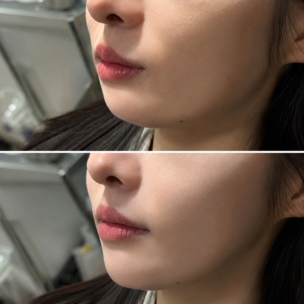 Double chin removal result — SkinAfinity Aesthetic Clinic