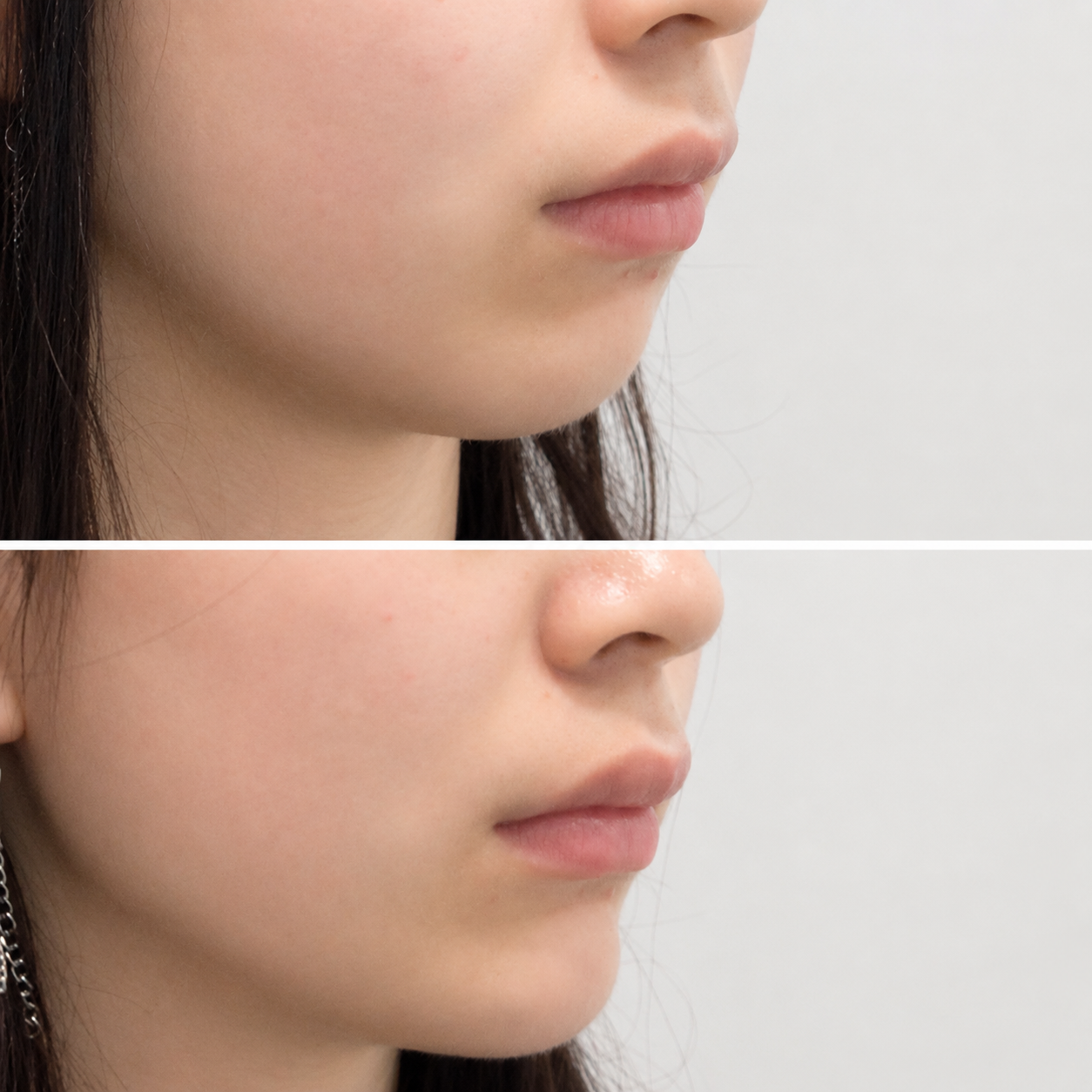 Submental fat reduction before and after — SkinAfinity