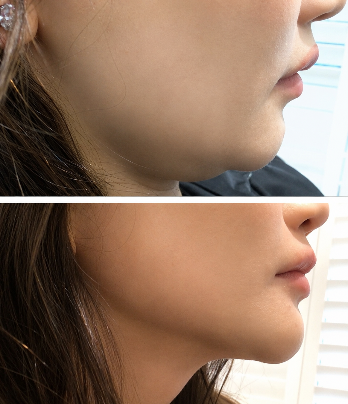 Double chin treatment result — SkinAfinity Aesthetic Clinic