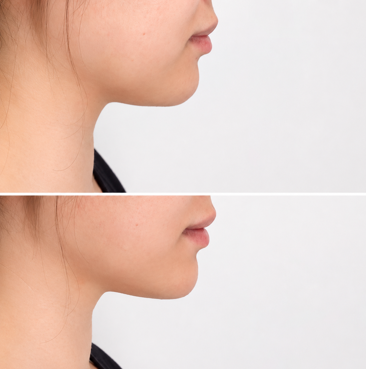 Double chin removal Adelaide before and after — Lina Pan RN