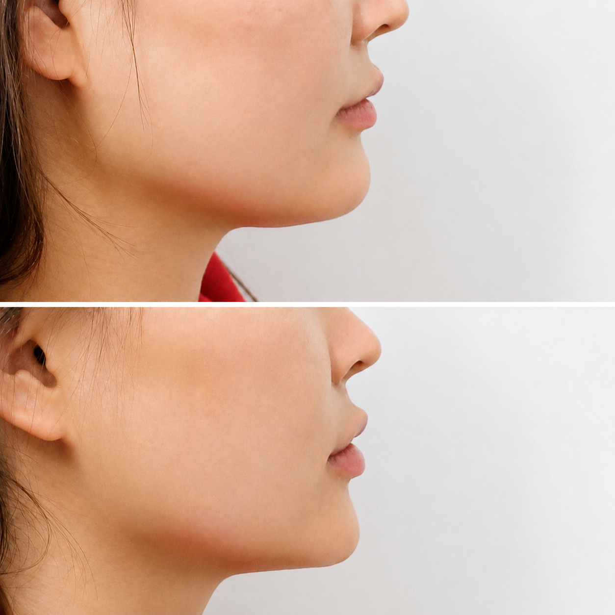 Fat reduction treatment before and after — SkinAfinity