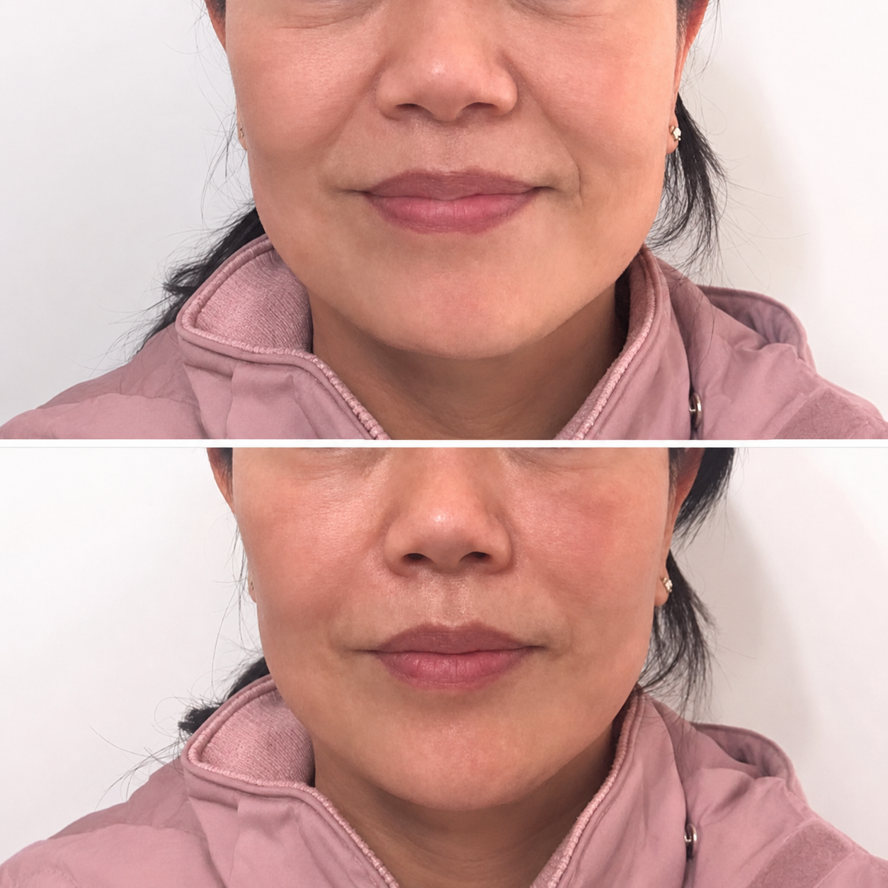 Non-surgical chin contouring result — SkinAfinity Adelaide