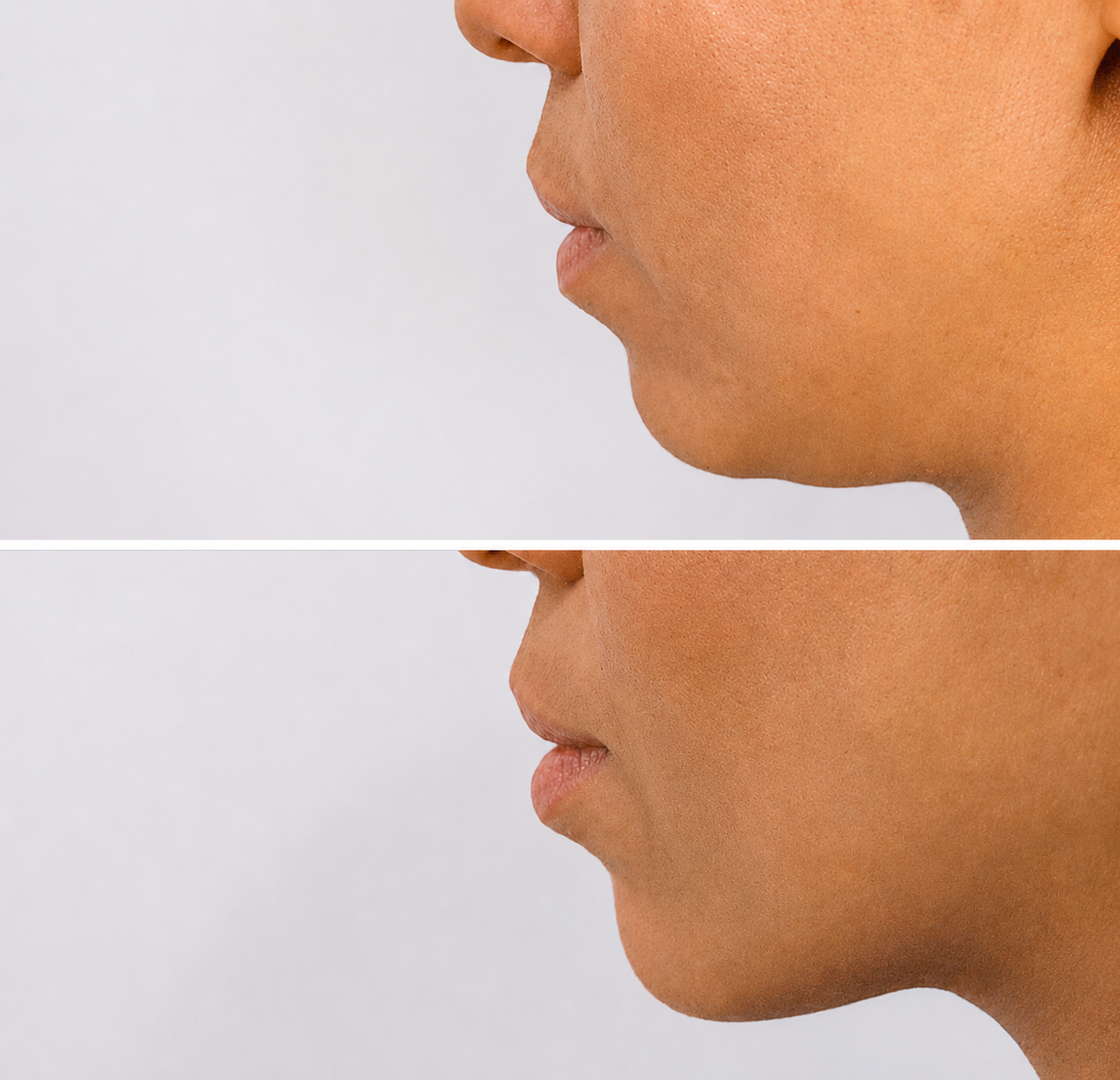Submental fat treatment result — Lina Pan RN Adelaide