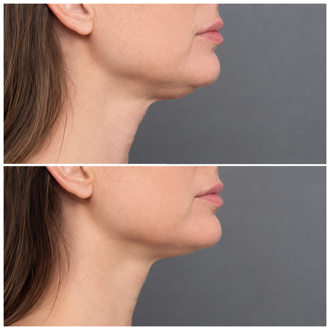 Double chin removal before and after — SkinAfinity Aesthetic Clinic Adelaide
