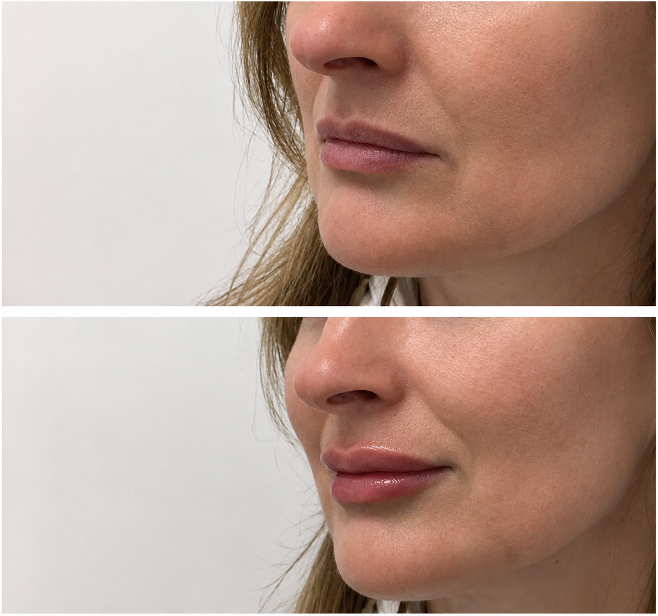 Lip filler before and after — SkinAfinity Aesthetic Clinic Adelaide