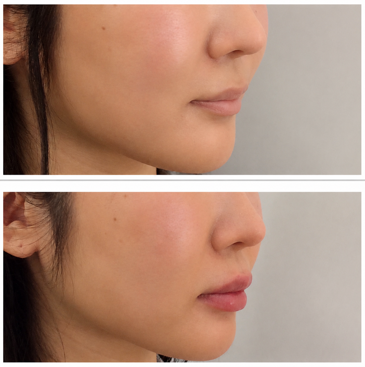Lip filler results Adelaide — Lina Pan RN, Somerton Park
