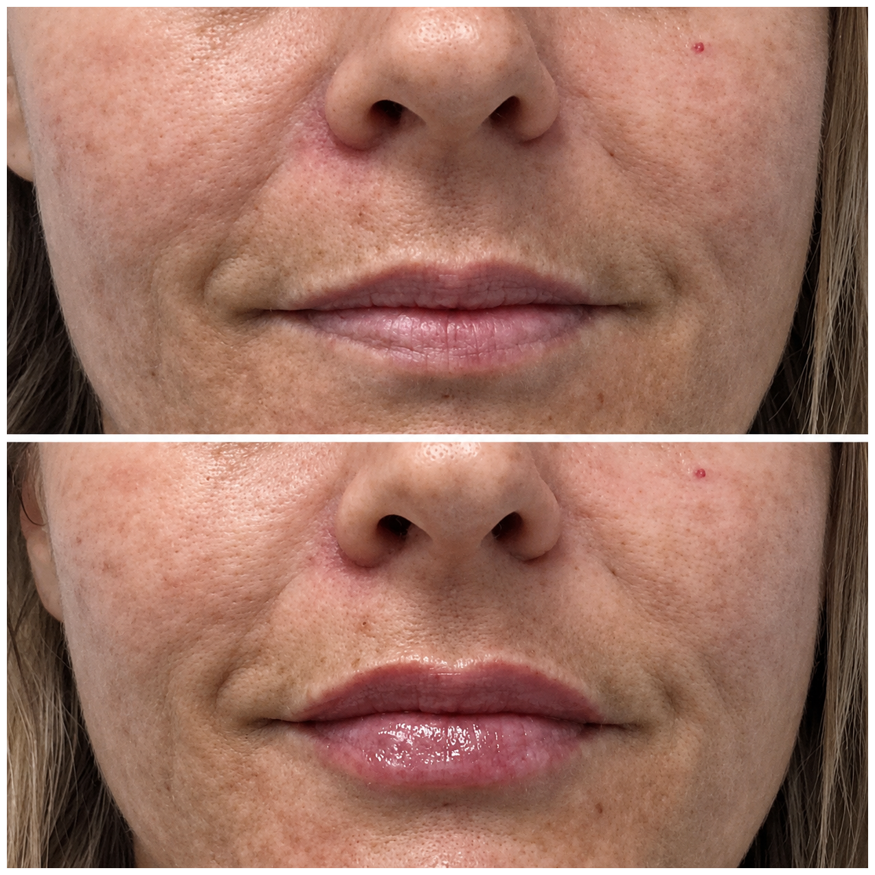 Lip enhancement before and after — SkinAfinity Aesthetic Clinic