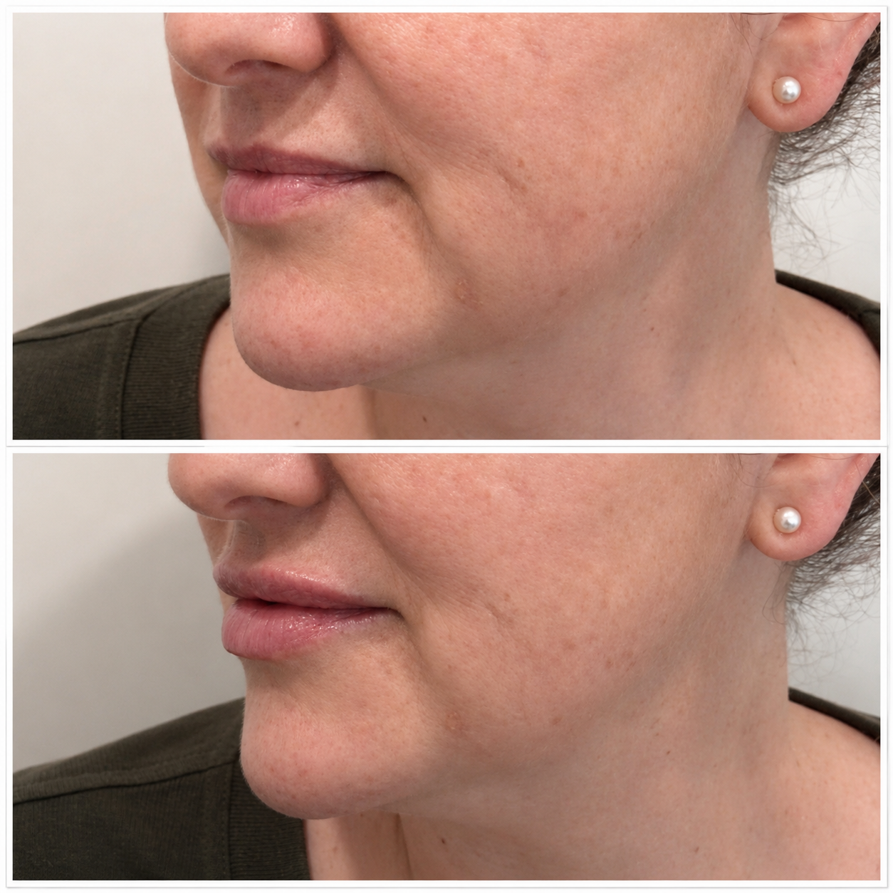 Lip filler before and after Adelaide — SkinAfinity Clinic