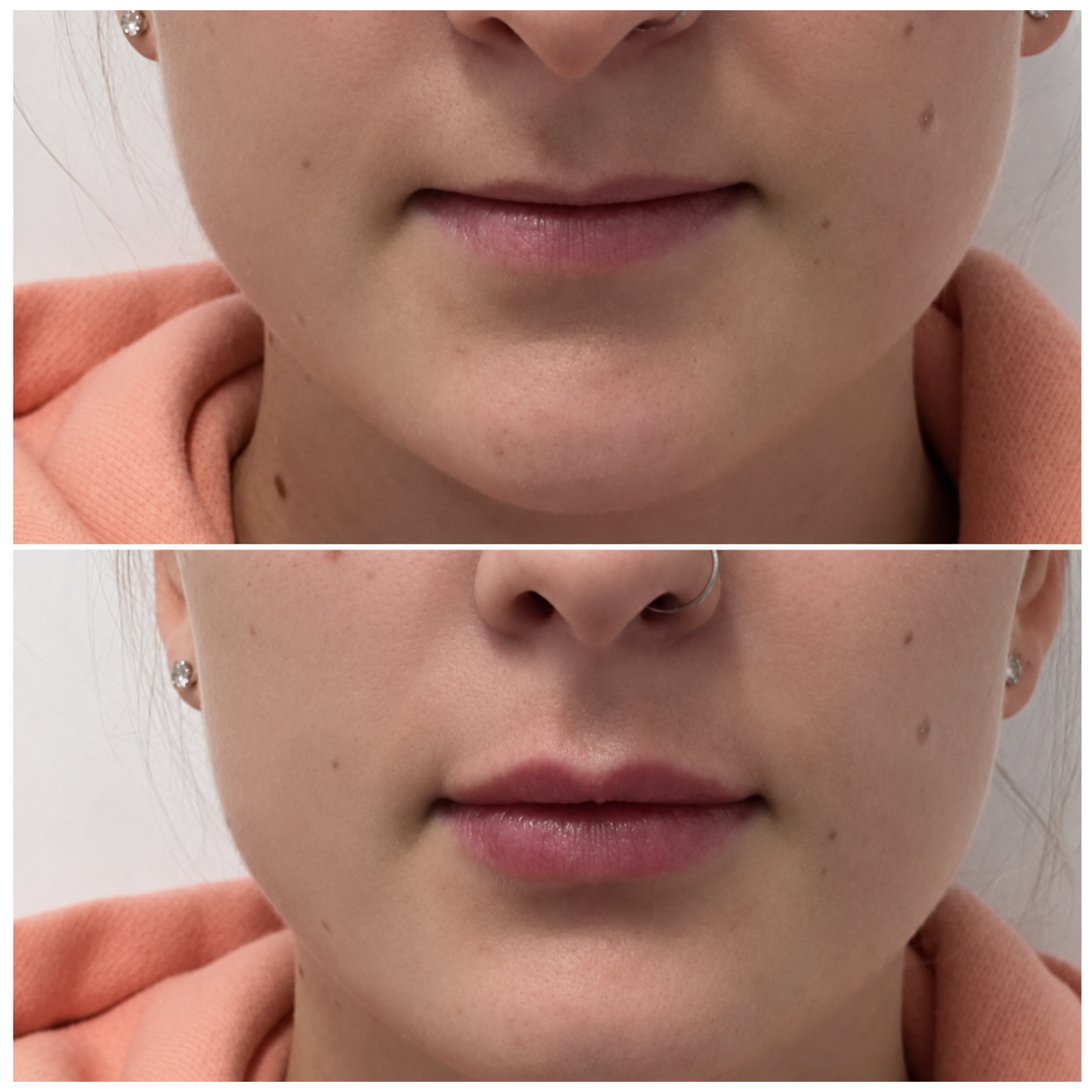 Lip enhancement result — SkinAfinity Aesthetic Clinic Adelaide