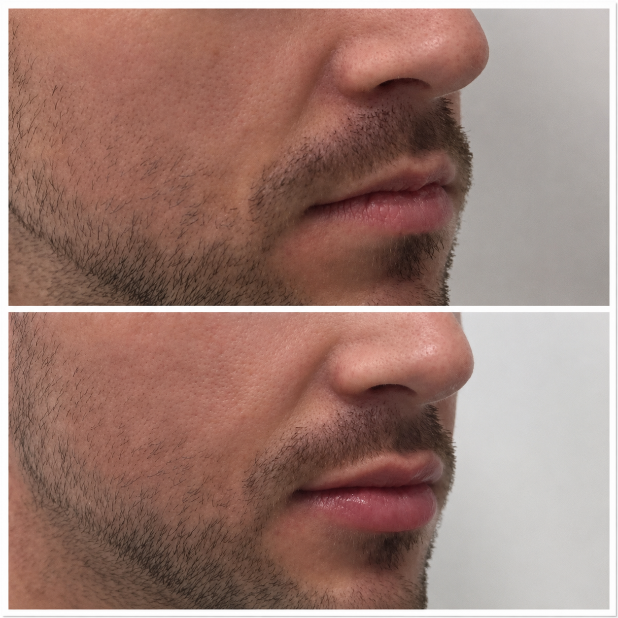 Lip filler before and after — Lina Pan RN, Somerton Park