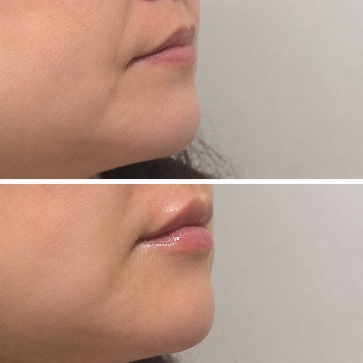 Lip filler results — SkinAfinity Aesthetic Clinic Adelaide