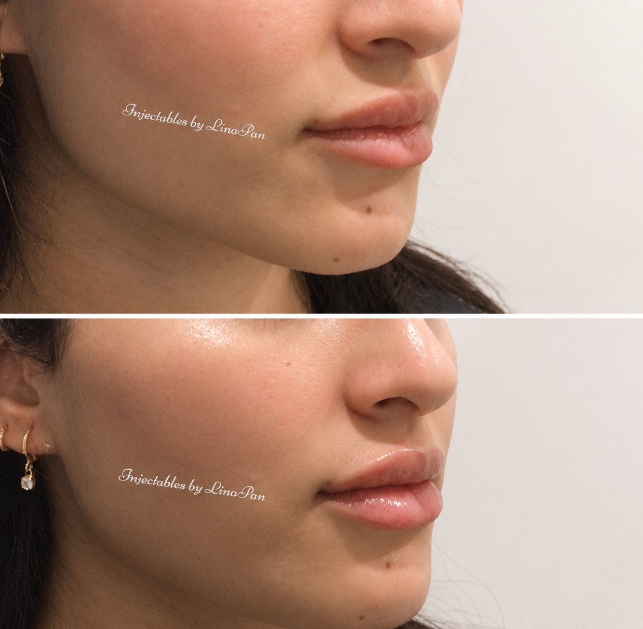 Natural lip enhancement before and after — Lina Pan RN Adelaide