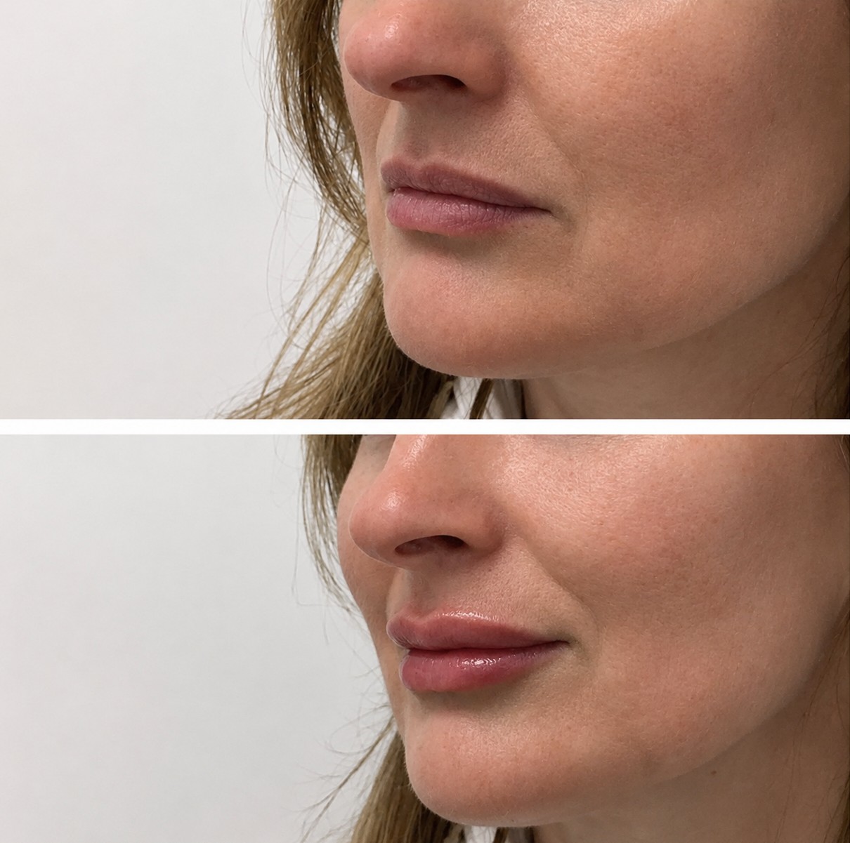 Lip Filler Results — SkinAfinity Adelaide