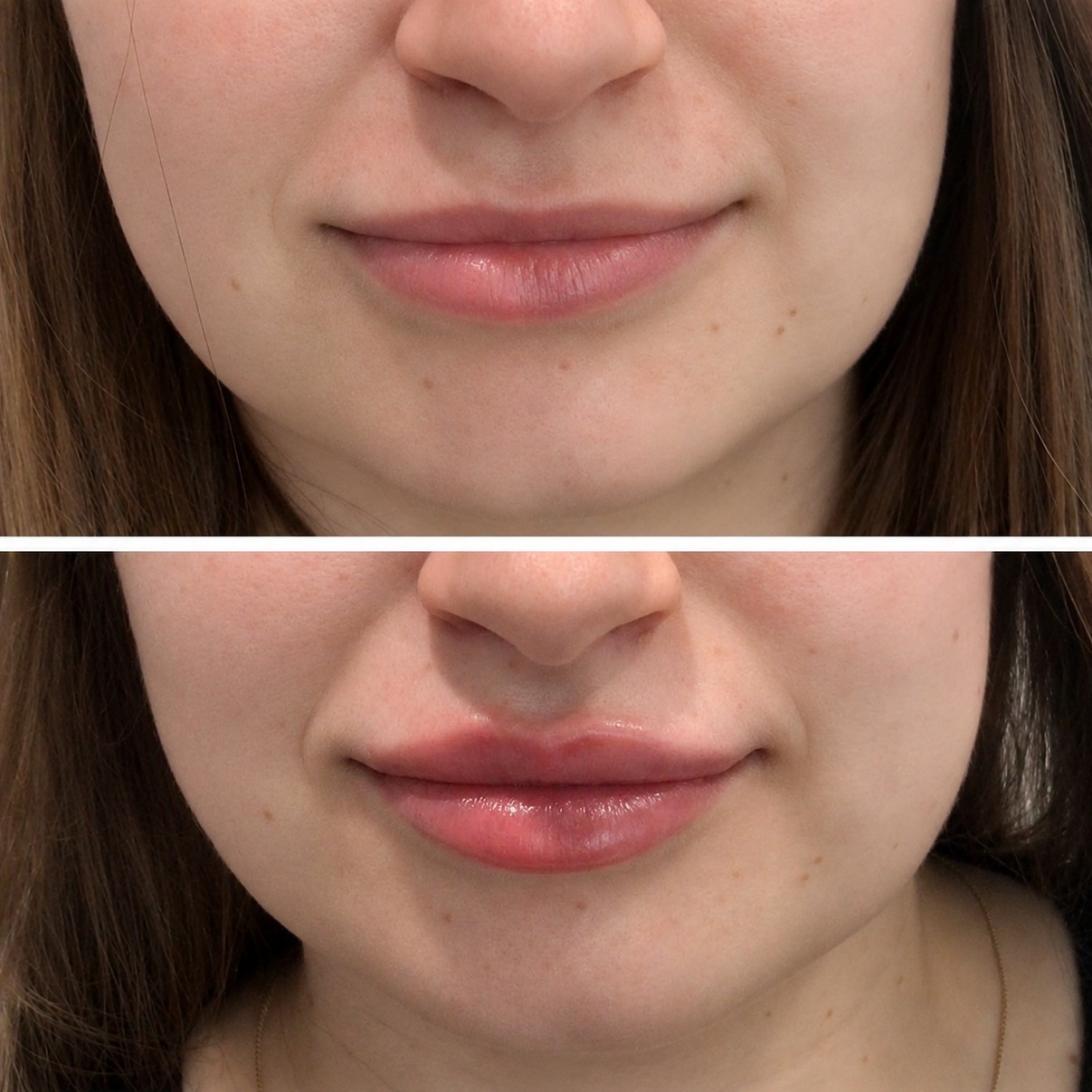 Lip Filler Before and After — Lina Pan RN