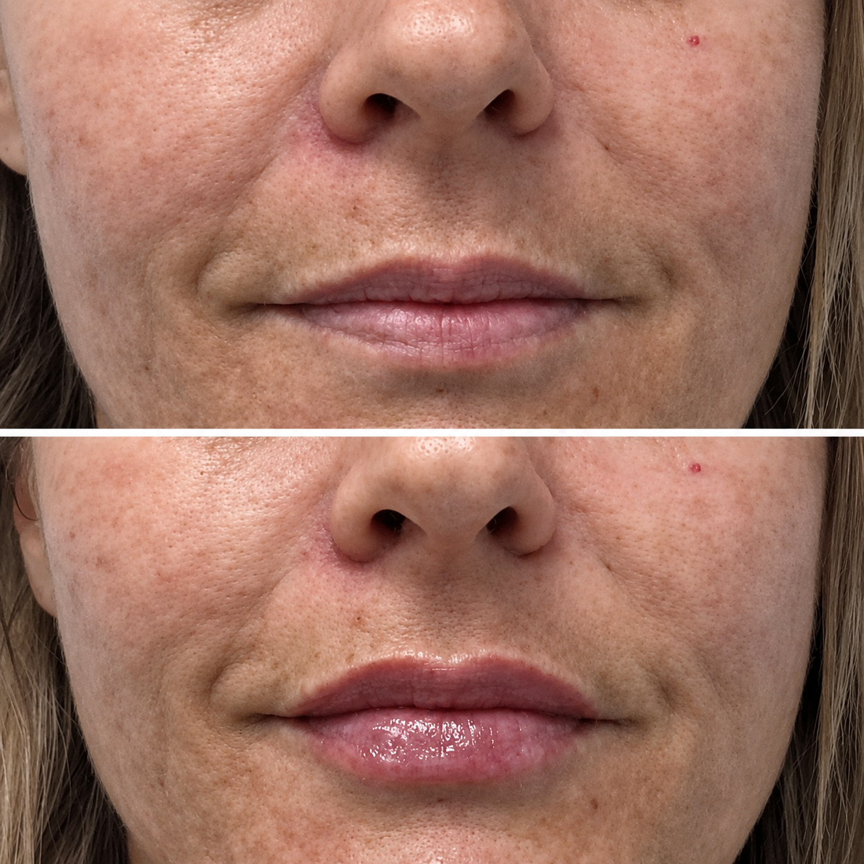 Natural lip filler results — SkinAfinity Somerton Park