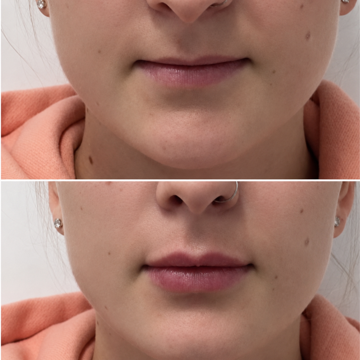 Lip filler before and after Adelaide — SkinAfinity