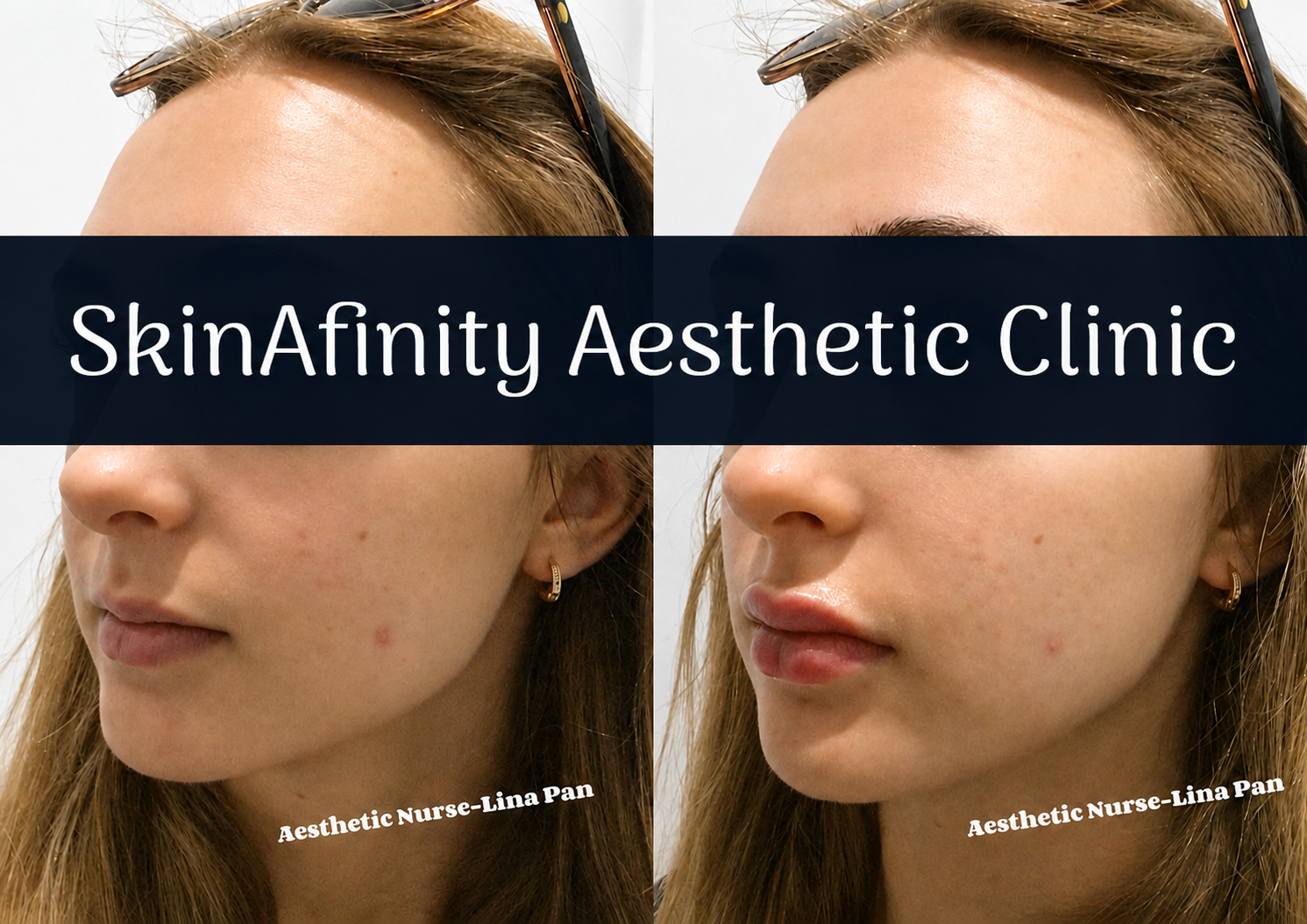 Lip filler result — SkinAfinity Aesthetic Clinic