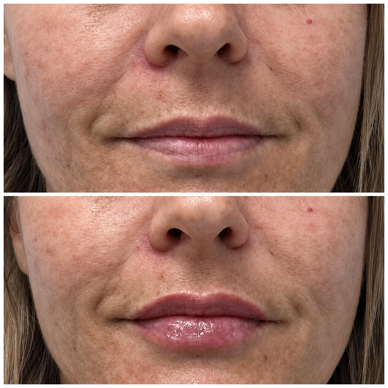 Lip filler before and after — SkinAfinity Aesthetic Clinic Adelaide