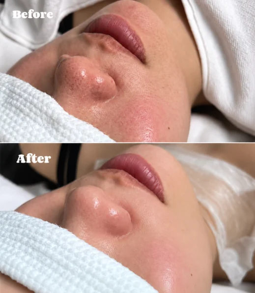 Skin booster glass facial before and after — SkinAfinity Aesthetic Clinic Adelaide