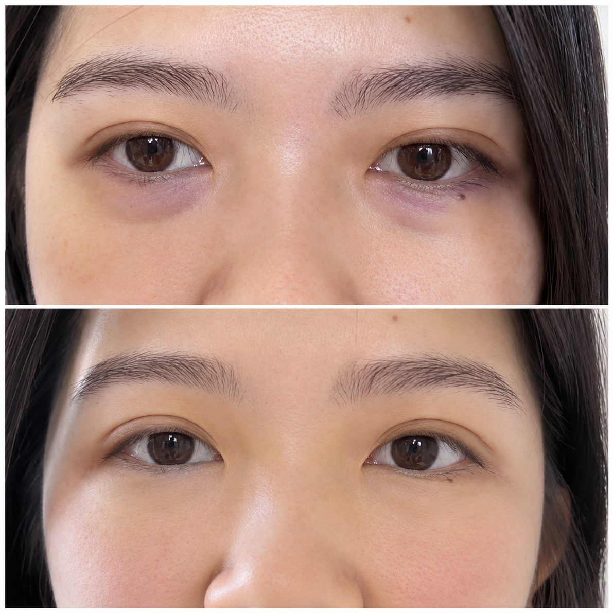 Under eye bag removal before and after — SkinAfinity Aesthetic Clinic Adelaide
