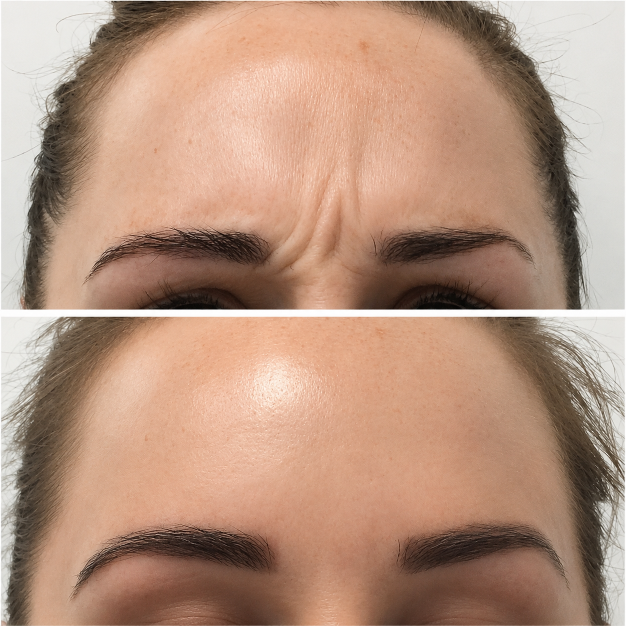 Anti-wrinkle injections result — Lina Pan RN, Somerton Park
