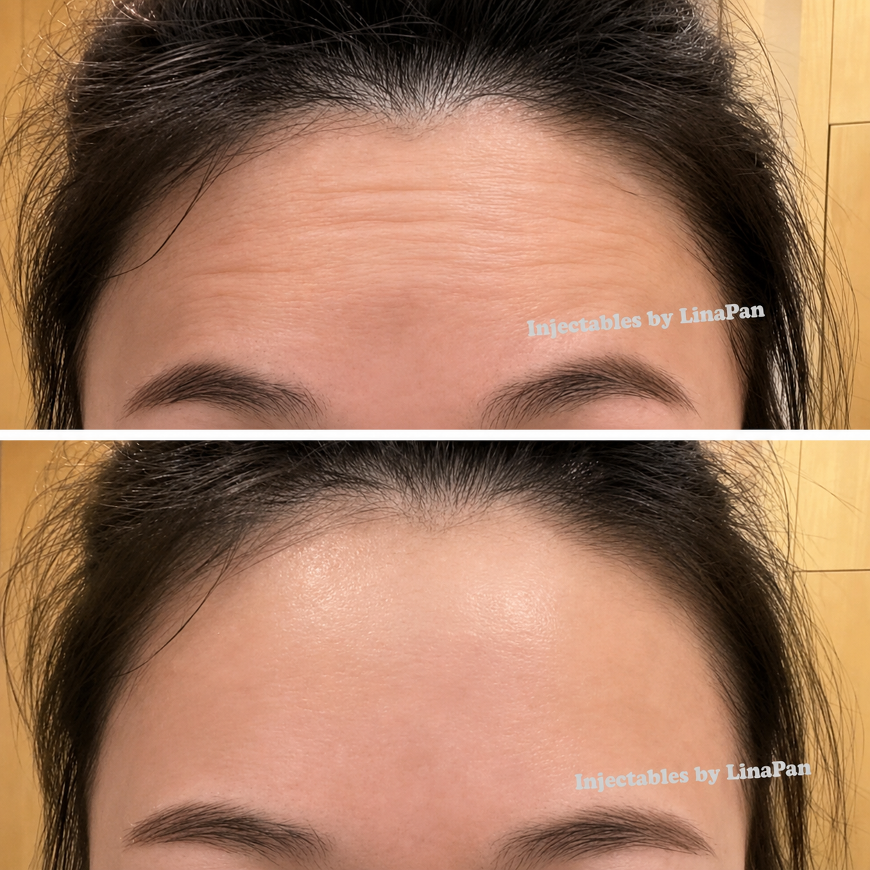 Forehead lines treatment before and after — SkinAfinity Adelaide