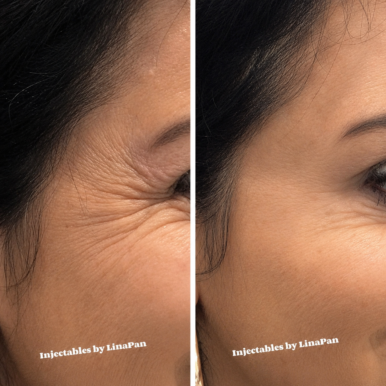 Frown line injections before and after — SkinAfinity Adelaide