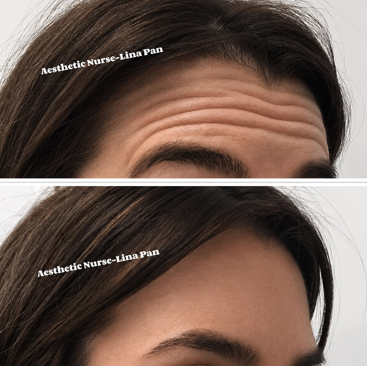 Crow's feet treatment result — SkinAfinity Aesthetic Clinic