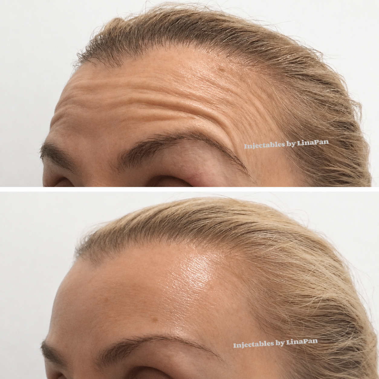 Wrinkle relaxing treatment before and after — Lina Pan RN