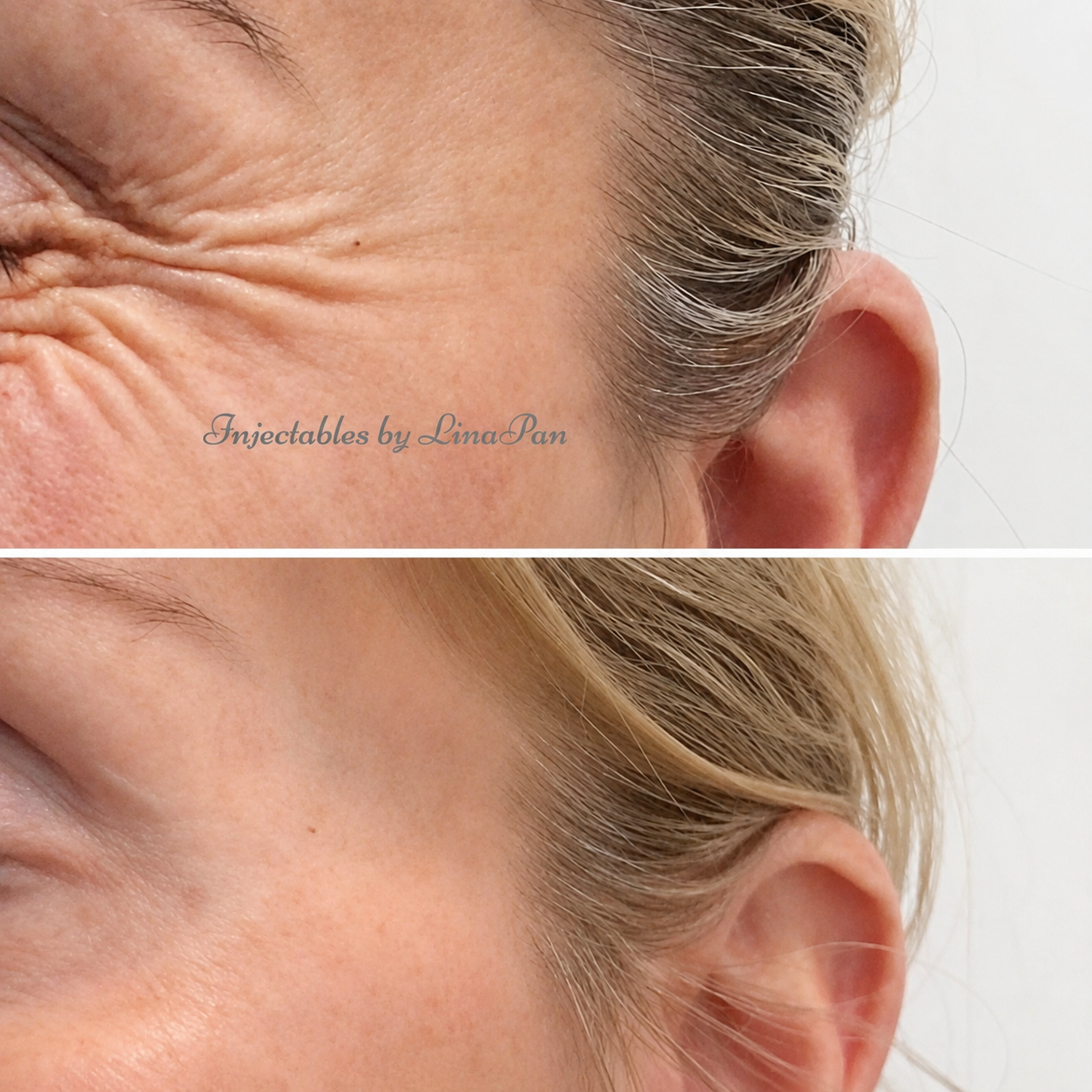 Wrinkle reduction injections Adelaide result — SkinAfinity