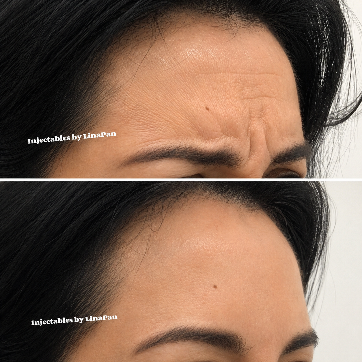 Anti-wrinkle before and after Adelaide — SkinAfinity Clinic