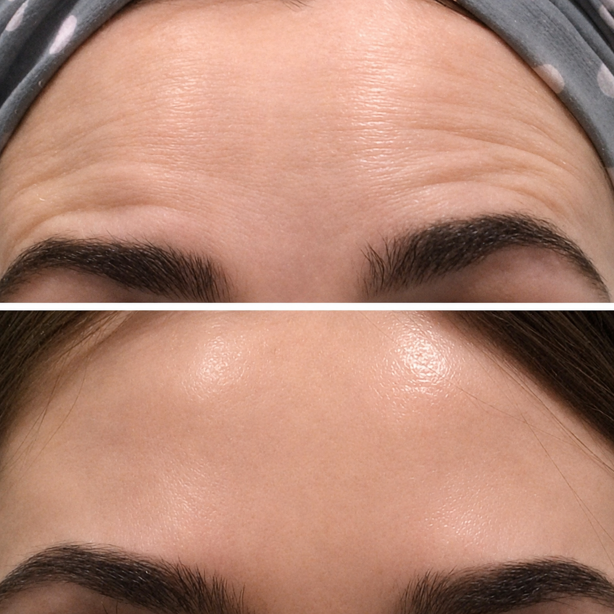 Wrinkle treatment before and after — SkinAfinity Aesthetic Clinic Adelaide